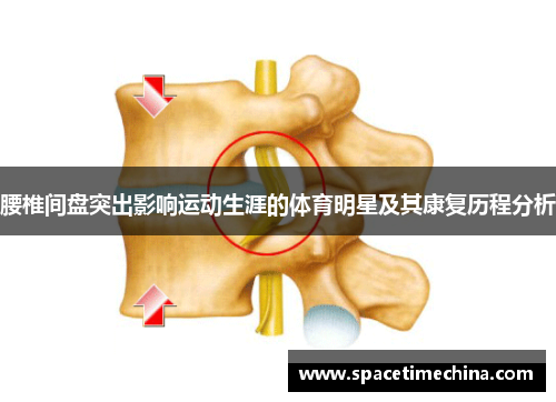 腰椎间盘突出影响运动生涯的体育明星及其康复历程分析